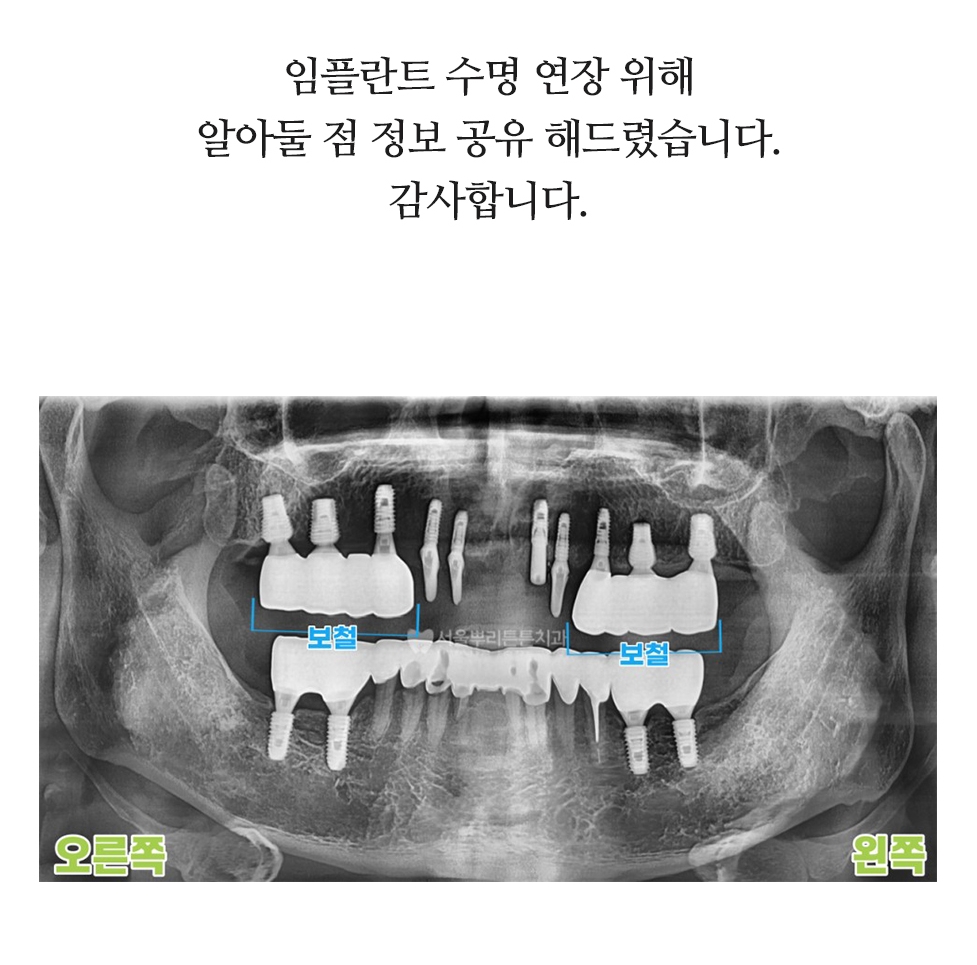 부산치과 임플란트 이미지 (14)