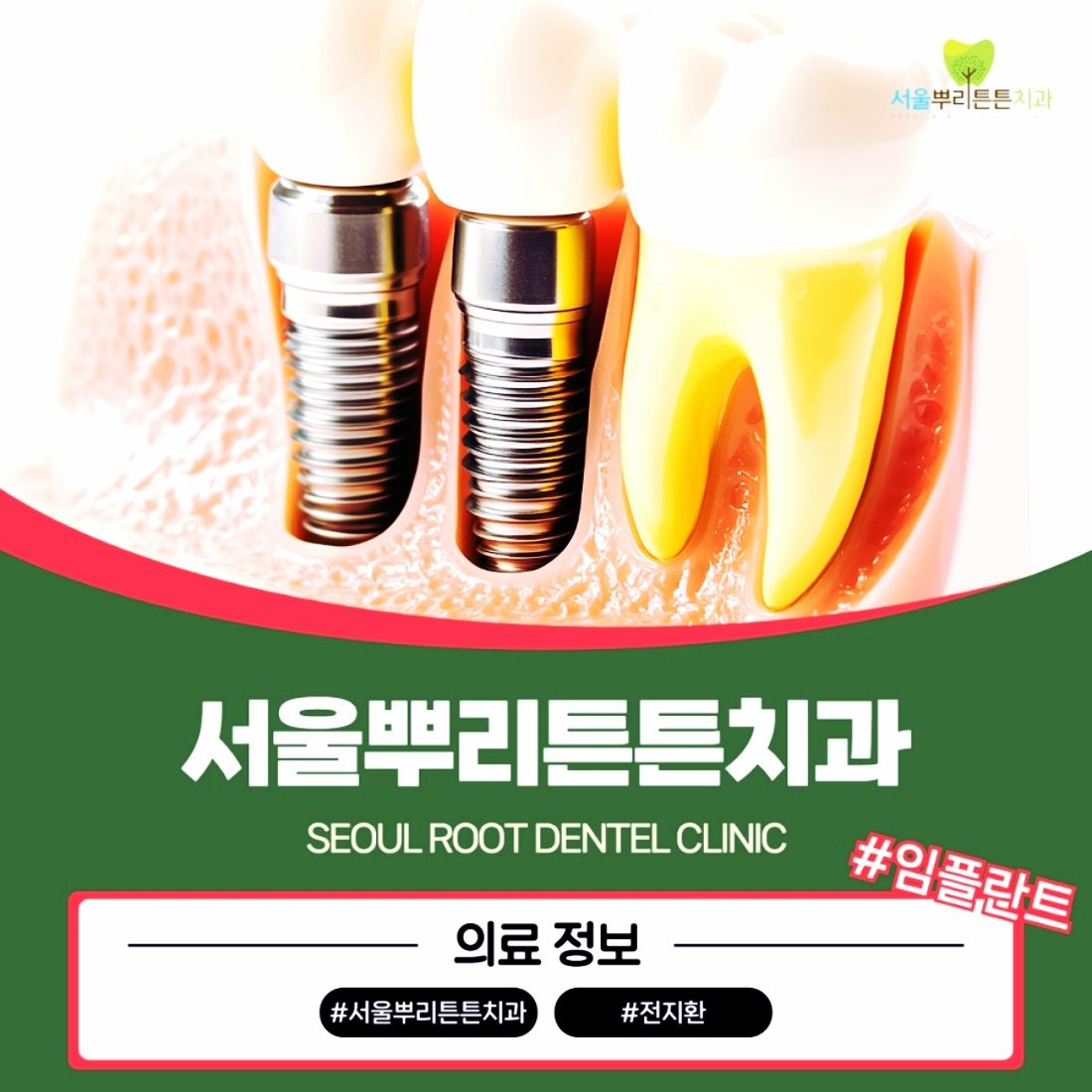 연산동 연산역 치과 임플란트 비용